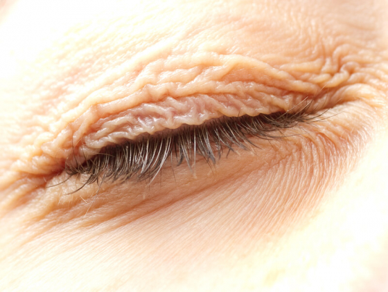 close up of closed eye due to entropian